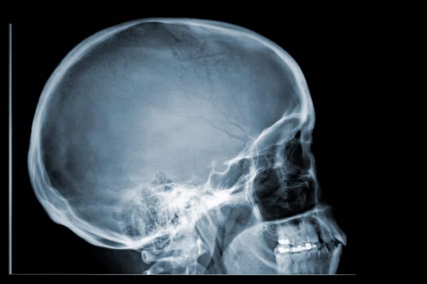Side view X-ray image of a human skull, showing the bones of the head, jaw, and upper neck against a black background.