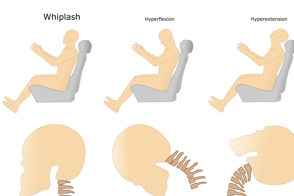 Diagram showing whiplash injury: seated person’s neck moves from neutral to hyperflexion to hyperextension, with corresponding illustrations of cervical spine movement.