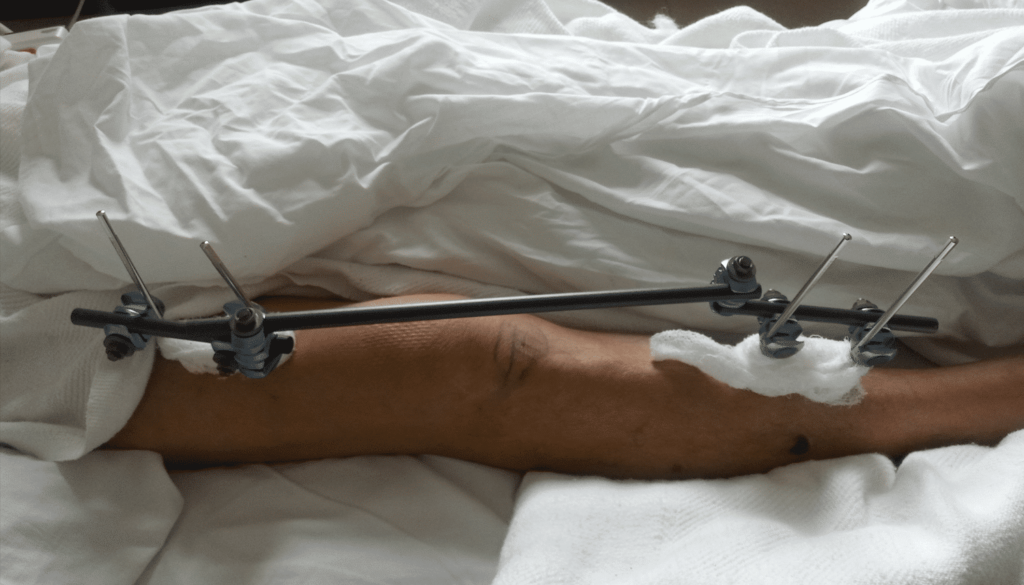 A person's leg with an external metal fixator attached, resting on a hospital bed and partially covered by a white sheet.