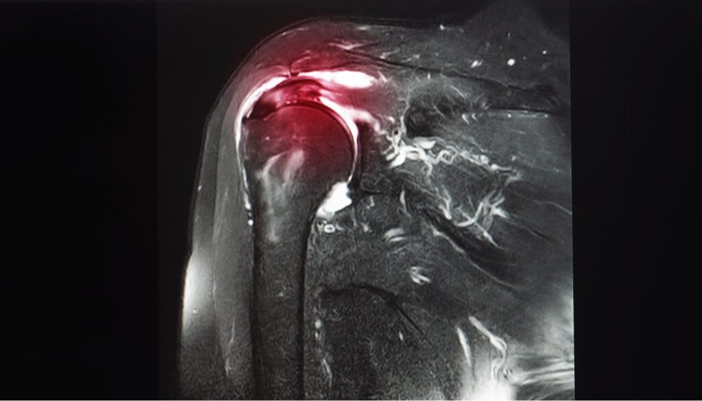 MRI scan of a shoulder joint highlighting inflammation or abnormality in the rotator cuff area with a red tint.